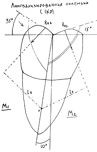Рис. 2. Отсутствие контакта R<sub>n1</sub> при лингвализированной окклюзии.